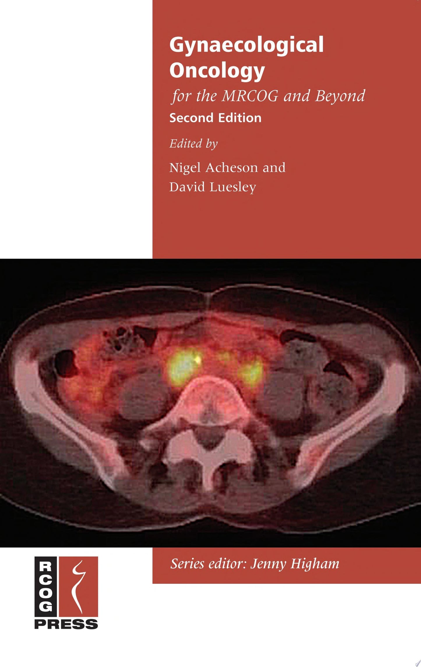 Gynaecological Oncology for the MRCOG and Beyond, 2nd Edition