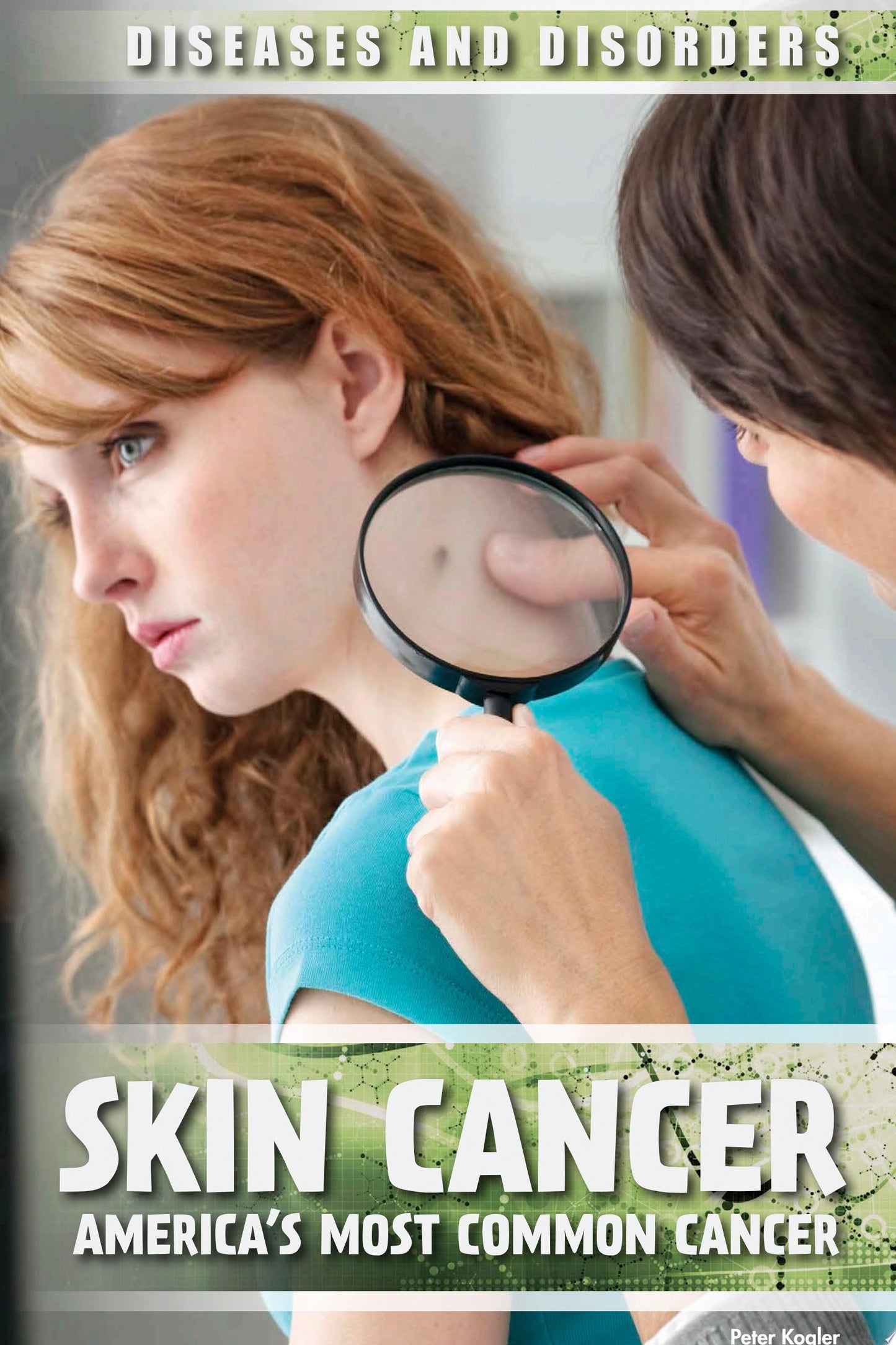 Skin Cancer
