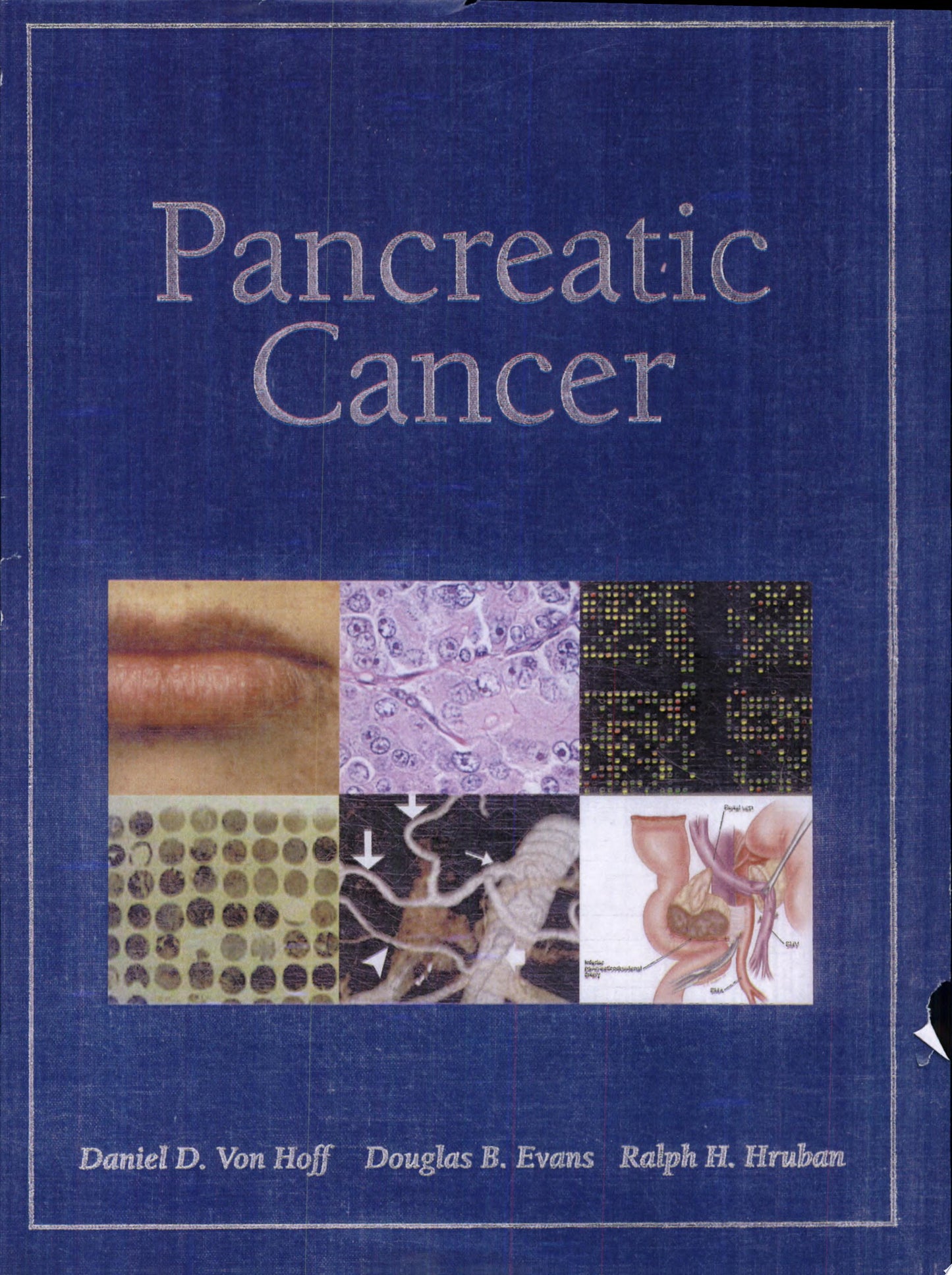 Pancreatic Tumors